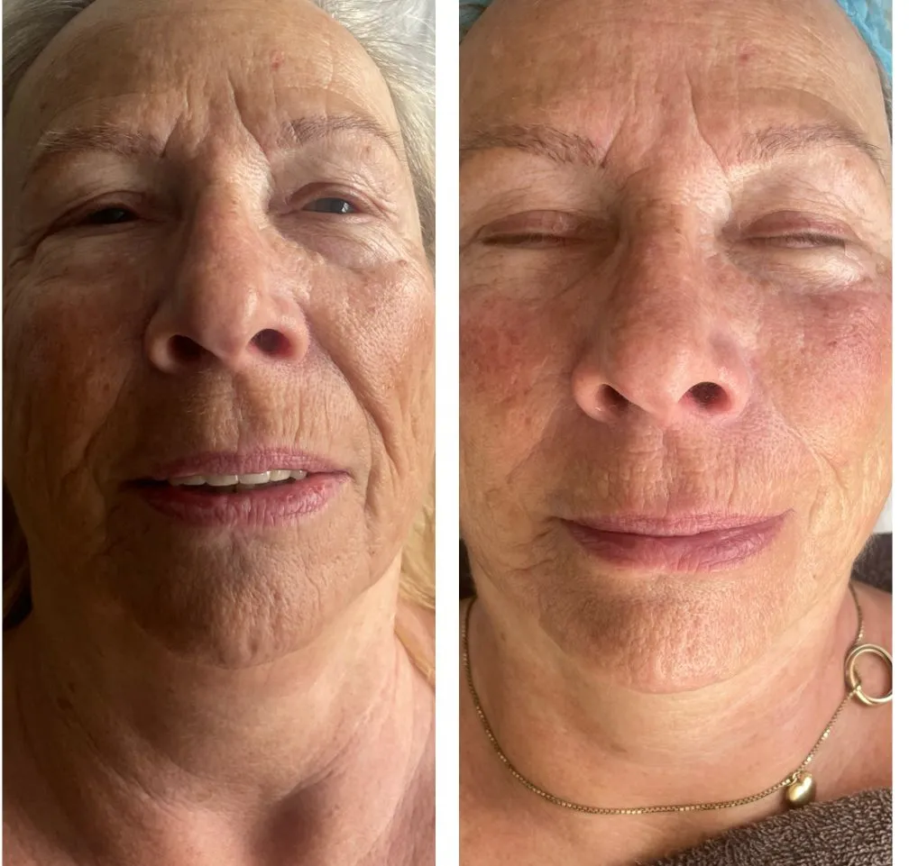 beauty salon resultaten 3 RF behandeling