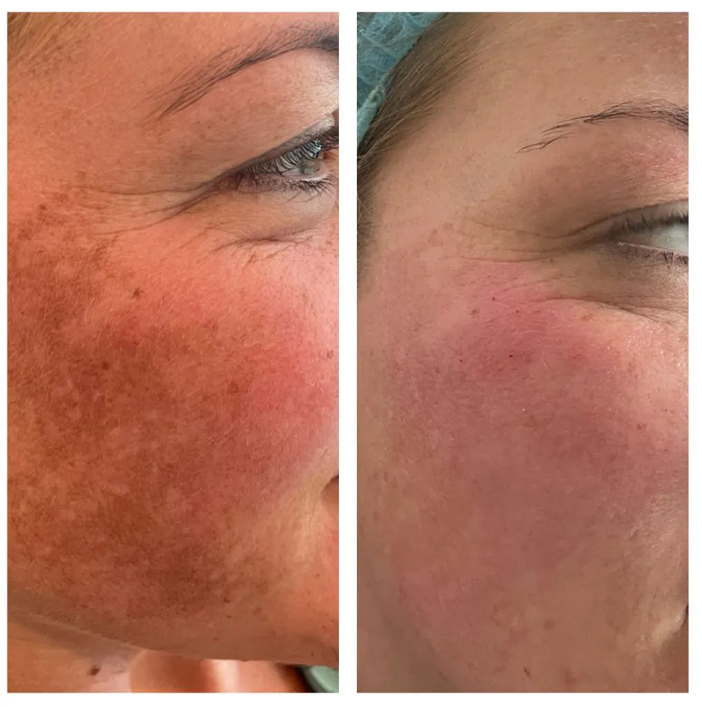 beauty salon resultaten behandeling huidverzorging